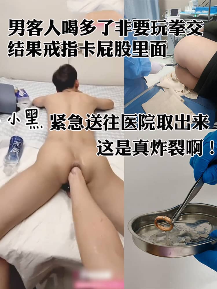 男客人喝多了非要玩拳交 结果戒指卡屁股里面 紧急送往医院取出来 这是真炸裂啊！
